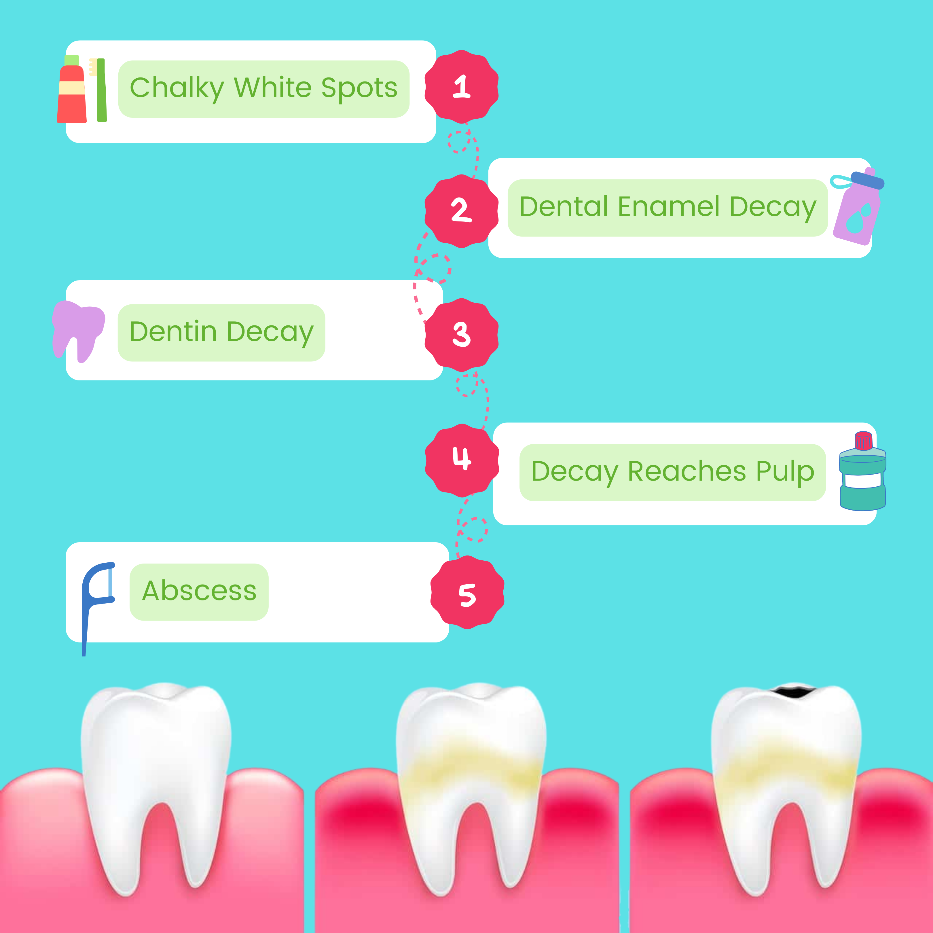 The Stages Of Tooth Decay Lakeview Pointe Dentistry